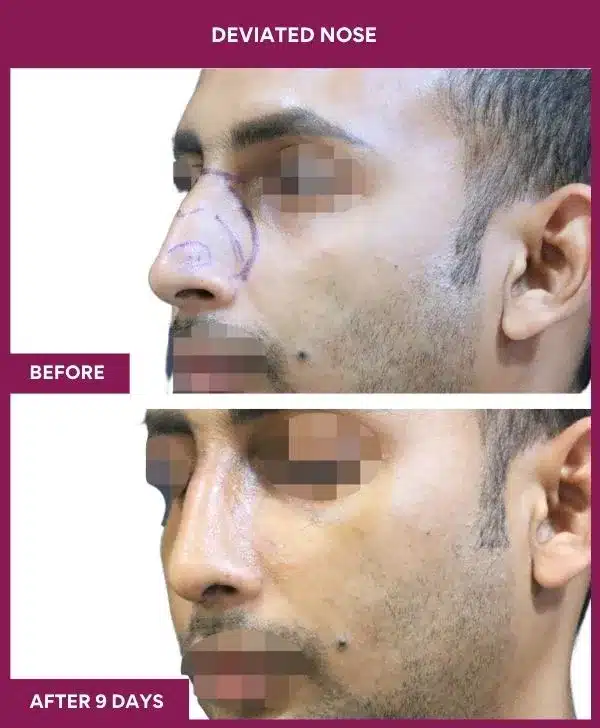 10 deviated nose_36 in Mumbai, India