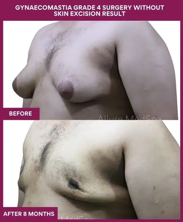 11- GYNAECOMASTIA GRADE 4 SURGERY WITHOUT SKIN EXCISION RESULT (2)_