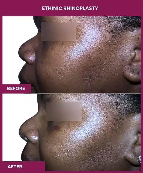 12 ETHINIC RHINOPLASTY in Mumbai, India