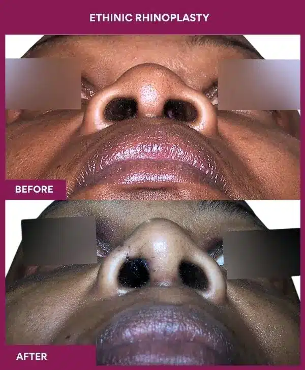 12 ETHINIC RHINOPLASTY in Mumbai, India