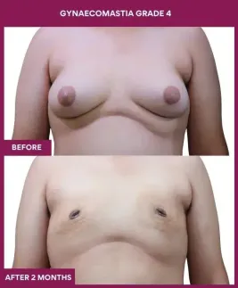 12- GYNAECOMASTIA GRADE 4_