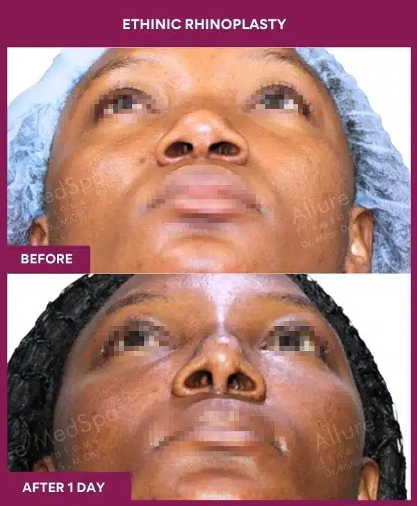 13 ETHINIC RHINOPLASTY in Mumbai, India