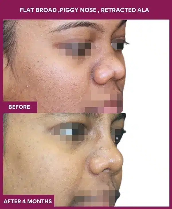 14 FLAT BROAD ,PIGGY NOSE , RETRACTED ALA_46_ (2)