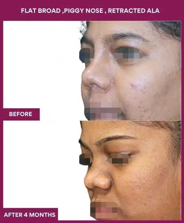 14 FLAT BROAD ,PIGGY NOSE , RETRACTED ALA in Mumbai, India