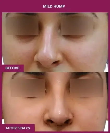 15 MILD HUMP in Mumbai, India