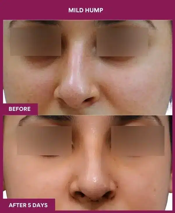 15 MILD HUMP in Mumbai, India