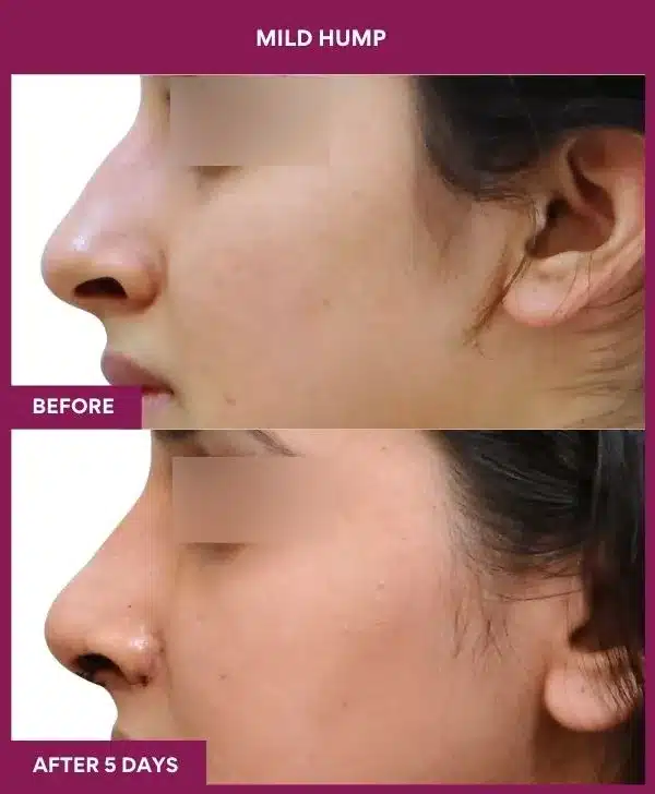 15 MILD HUMP in Mumbai, India