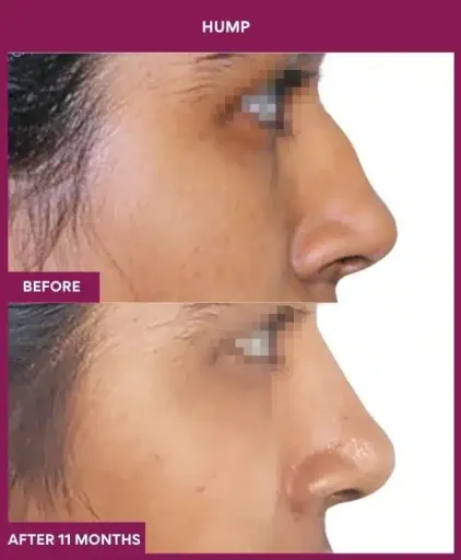 16 hump Nose in Mumbai, India