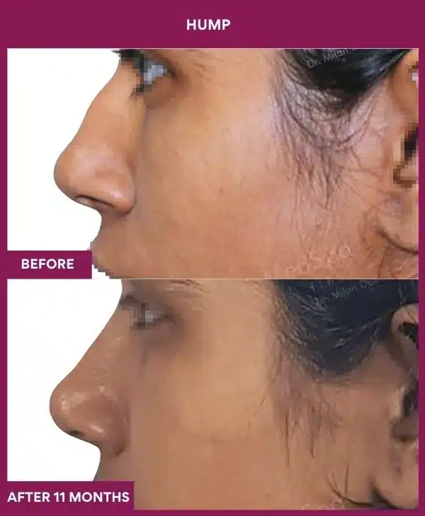 16 hump Nose in Mumbai, India