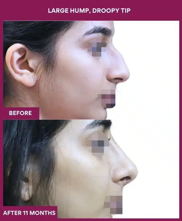 17 large Hump, droopy tip in Mumbai, India