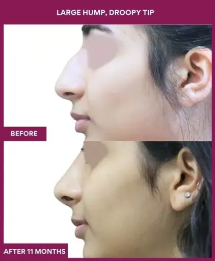 17 large Hump, droopy tip in Mumbai, India