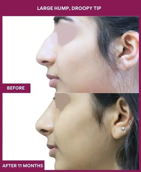 17 large Hump, droopy tip in Mumbai, India