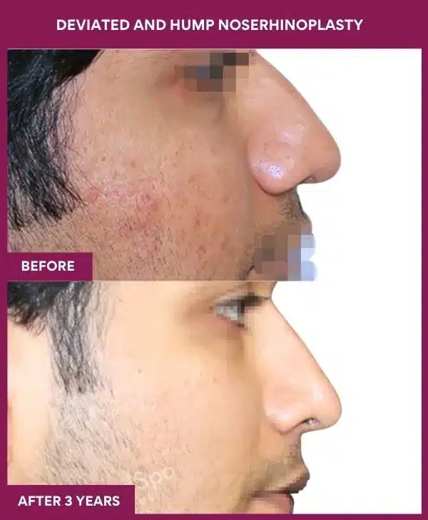 18 DEVIATED AND HUMP NOSERHINOPLASTY in Mumbai, India