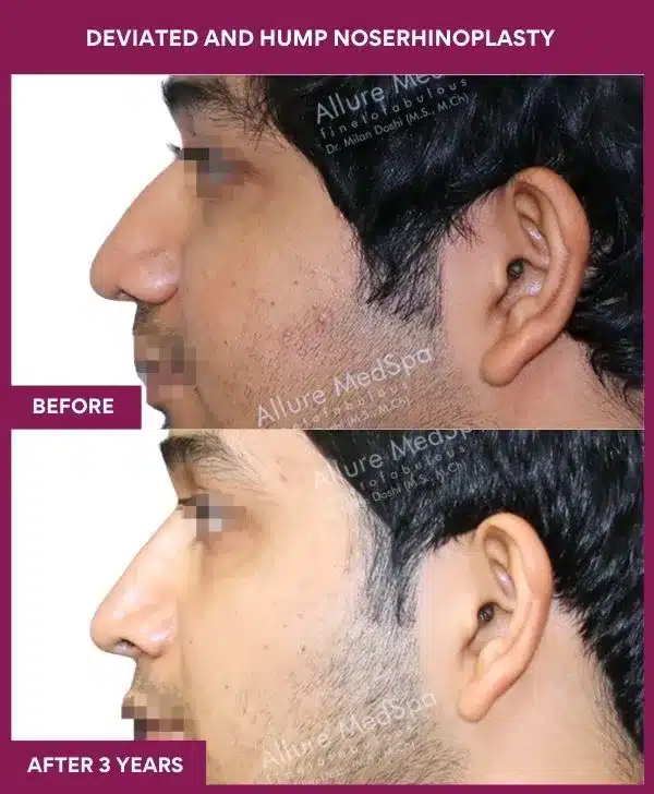 18 DEVIATED AND HUMP NOSERHINOPLASTY in Mumbai, India
