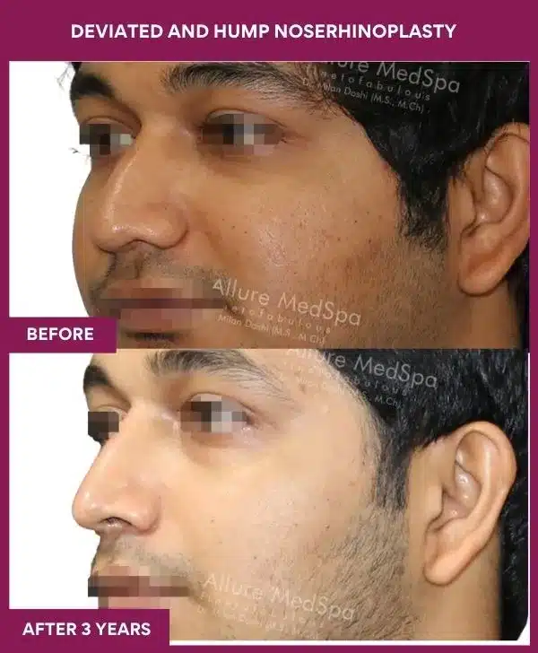 18 DEVIATED AND HUMP NOSERHINOPLASTY in Mumbai, India