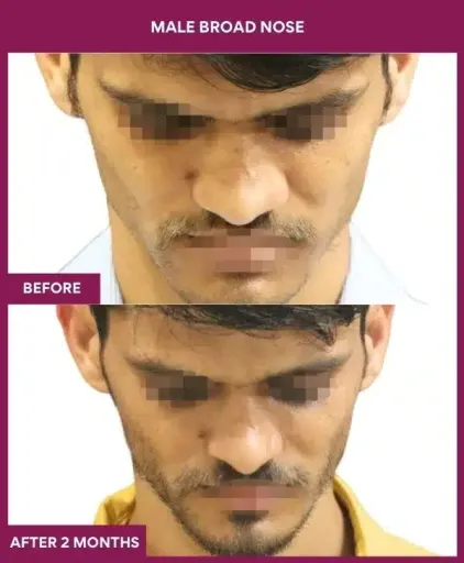 2 male broad nose in Mumbai, India