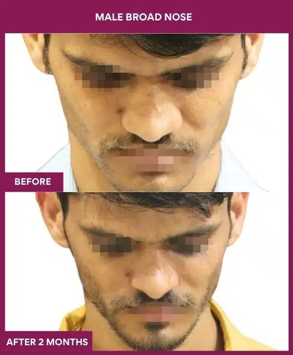 2 male broad nose in Mumbai, India