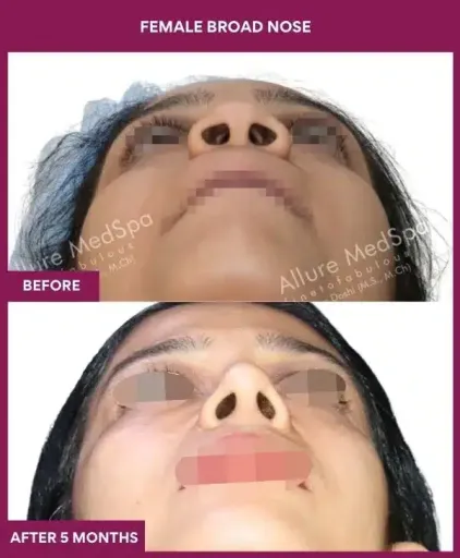 3 female BROAD NOSE in Mumbai, India