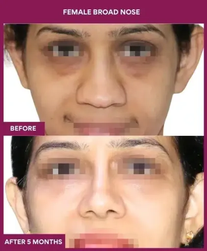 3 female BROAD NOSE in Mumbai, India