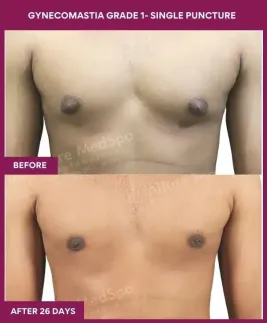 4- Gynecomastia grade 1- Single Puncture_