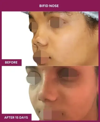5 BIFID NOSE surgery in Mumbai, India
