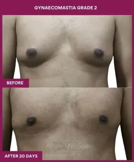 7-GYNAECOMASTIA GRADE 2