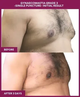 8-GYNAECOMASTIA GRADE 3 -SINGLE PUNCTURE- INITIAL RESULT (2)_