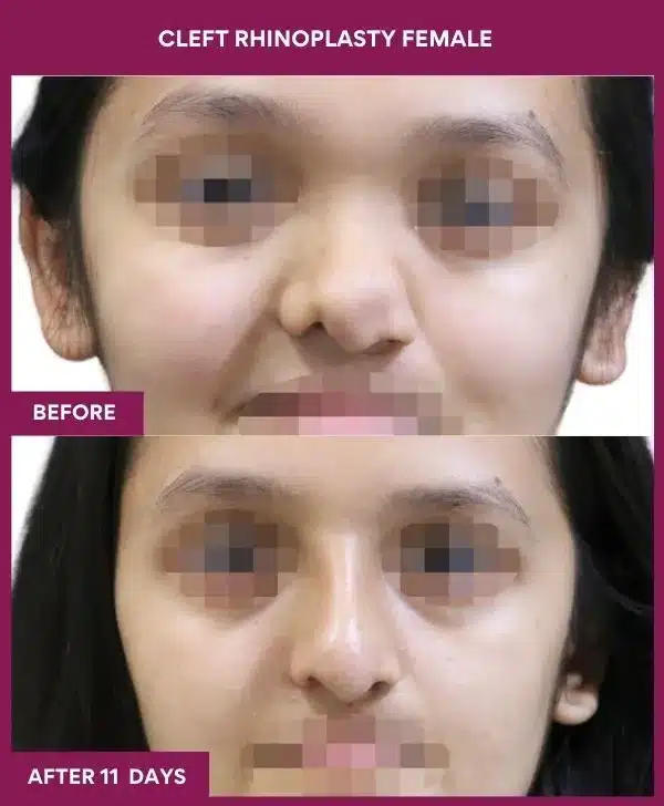 9 cleft rhinoplasty female_31 in Mumbai, India