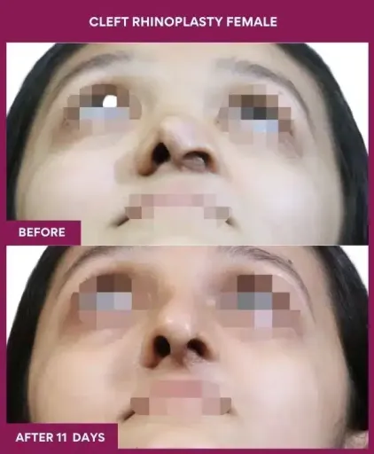 9 cleft rhinoplasty female_31 in Mumbai, India