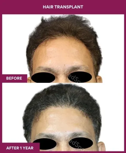 4 Hair Transplant (4)_10_