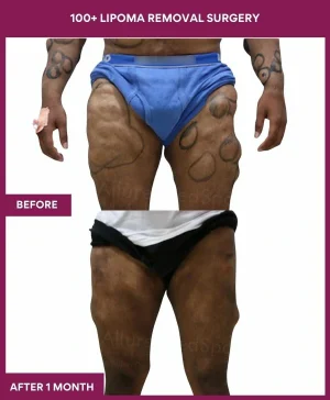 11 100+ Lipoma Removal Surgery (3)