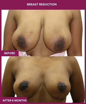 2-Breast Reduction_6_ (1)