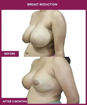3- Breast Reduction_9_ (3)