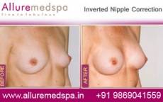 inverted-nipple-correction-before-and-after-pictures-mumbai-india