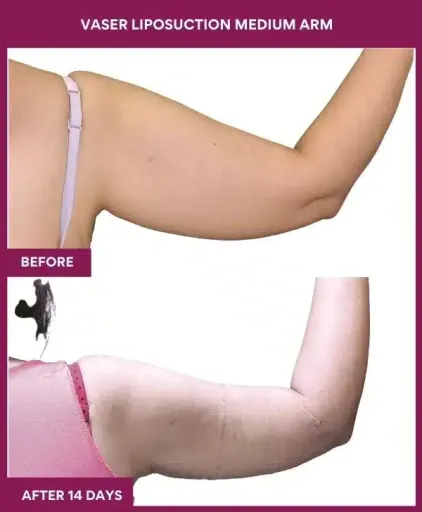 Vaser 35 16 VASER LIPOSUCTION MEDIUM ARM-