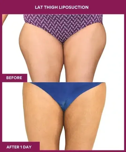 Vaser 21 20 LAT THIGH LIPOSUCTION