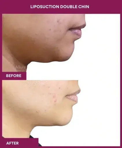 Vaser 34 23 LIPOSUCTION DOUBLE CHIN