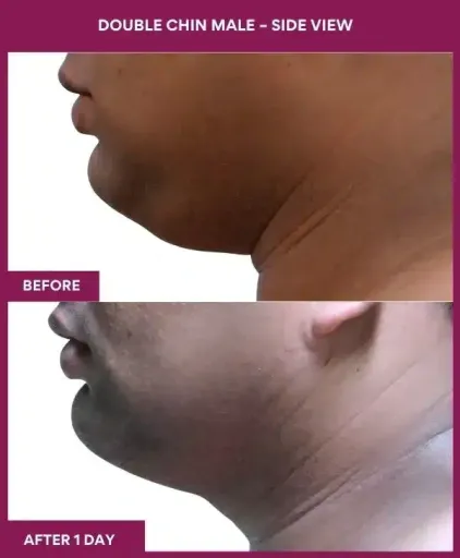 Vaser 31 24 Double Chin Male – Side View