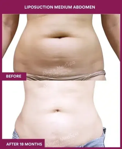 Vaser 12 6- liposuction medium abdomen