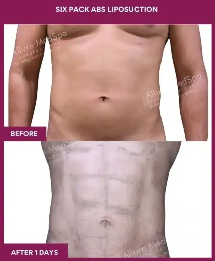 Vaser 15 8- Six Pack Abs Liposuction