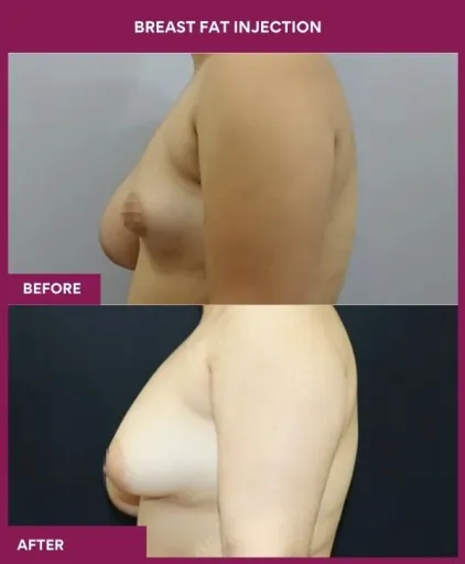Breast Asymmetry Surgery 11 1 Breast Fat Injection_3_ (2)