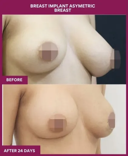 Breast Asymmetry Surgery 7 5 Breast implant asymetric breast_15_ (2)