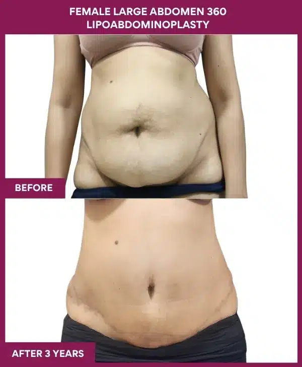 Female Large Abdomen 360 Lipoabdominoplasty Before After Image in Mumbai, India