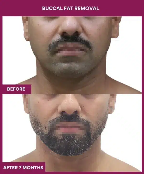 Buccal Fat Removal Before After Images in Mumbai, India