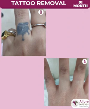 Tattoo removal treatment in Mumbai