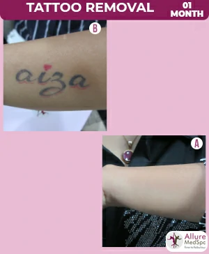 Tattoo removal treatment in Mumbai