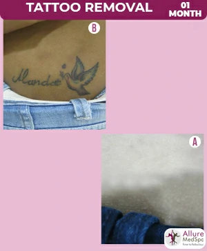 Tattoo removal treatment in Mumbai
