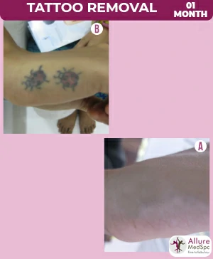 Tattoo removal treatment in Mumbai