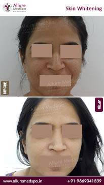 Skin-Brightening-Treatment-Before-and-After-Pictures