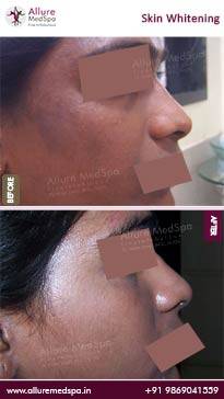 Skin-Whitening-Before-and-After-Result
